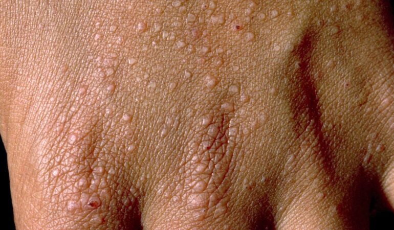 papular eczema