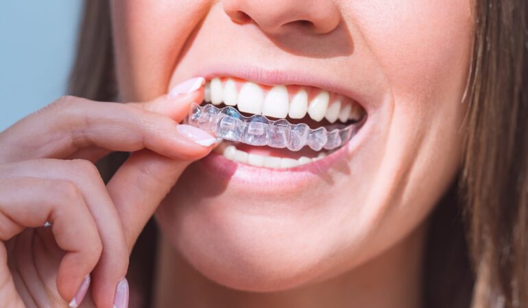 Invisalign Treatment