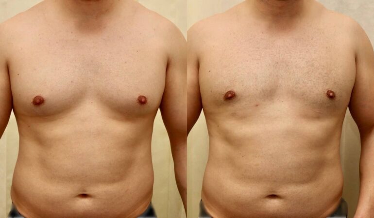 gynecomastia surgery abu dhabi