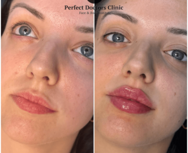 juvederm fillers