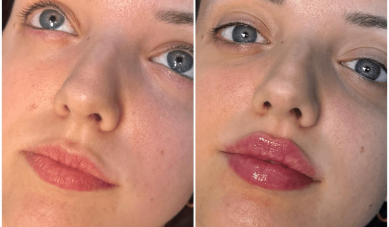 juvederm fillers