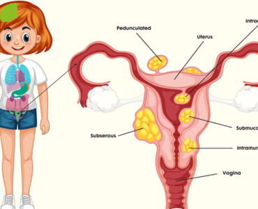 Uterine Fibroids Treatment