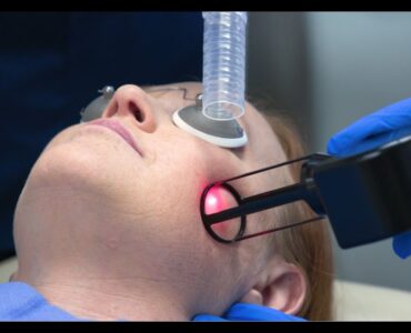 CO2 laser treatment