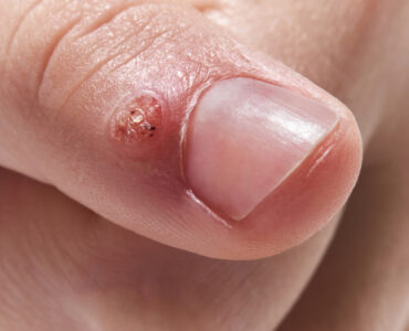 wart removal treatment